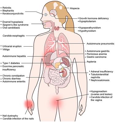 Autoimmune Polyendocrinopathy-Candidiasis-Ectodermal Dystrophy